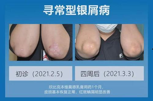 银屑病视频,视频深度解析疾病成因与防治策略